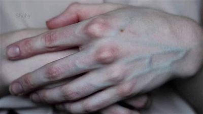 ماذا تظهر عروق بعض الناس من الجلد وتختفي عن آخرين